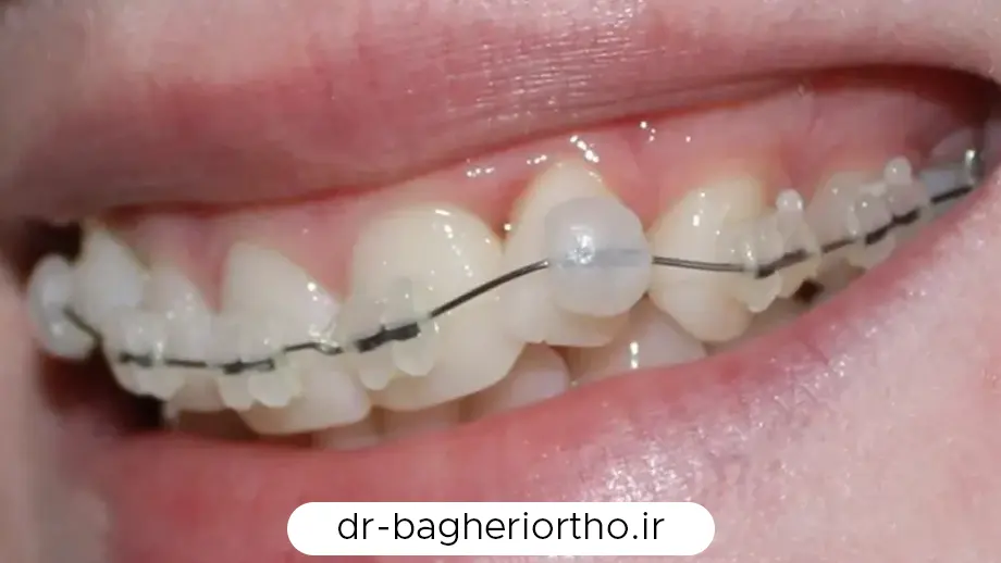 نمای نزدیک براکت‌های ارتودنسی و موم قرارگرفته روی یکی از براکت‌ها.